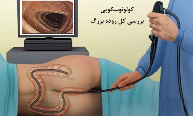 کولونوسکوپی بررسی کل روده بزرگ