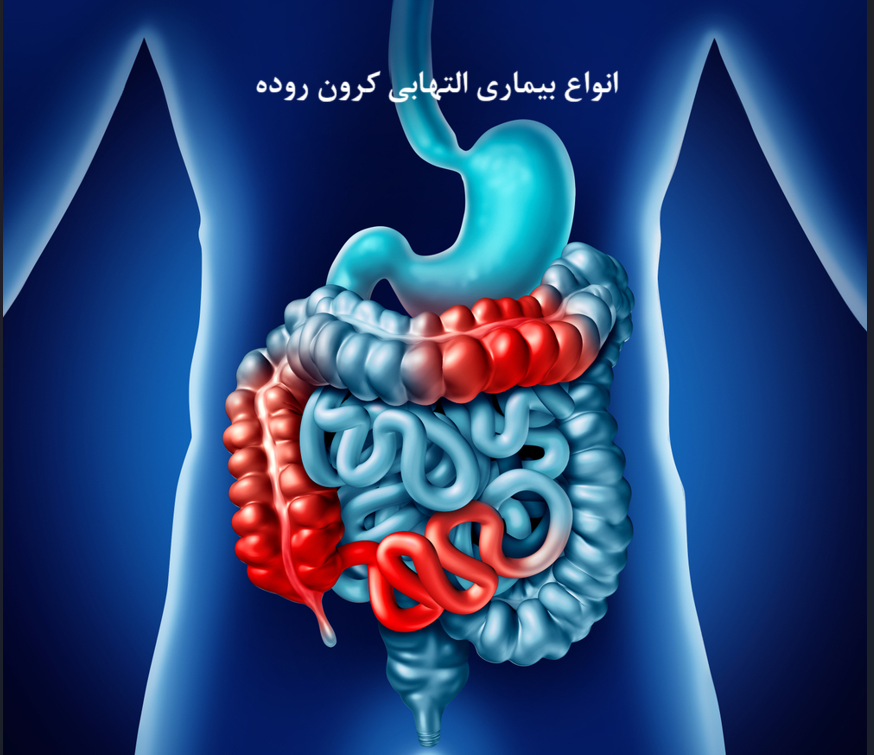 ۵ نوع شایع بیماری کرون: از التهاب روده تا اختلال در فعالیت سایر اندام ها 
