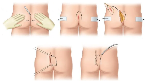 عمل کیست مویی به روش بسته: مراحل، شرایط و نکات مهم این روش