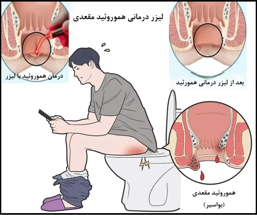 درمان هموروئید مقعدی با لیزر درمانی
