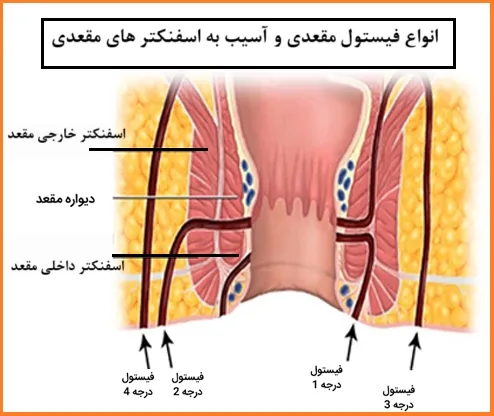 آسیب های وارده به عضلات اسفنکتر داخلی و خارجی مقعد: از زایمان تا فیستول