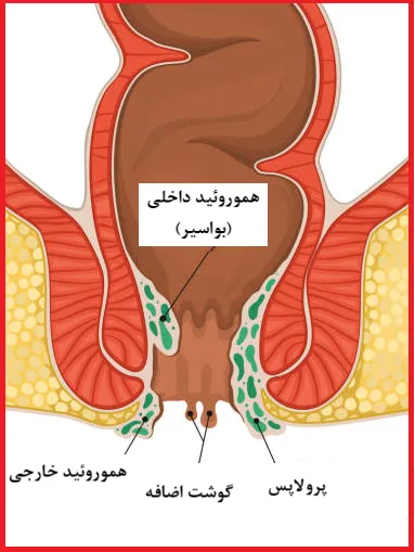 کلینیک لیزر درمان: بهترین مرکز درمان لیزری هموروئید مقعدی