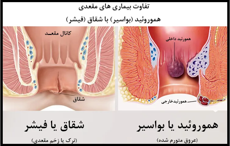  تفاوت ها و شباهت های دو بیماری هموروئید و شقاق مقعدی