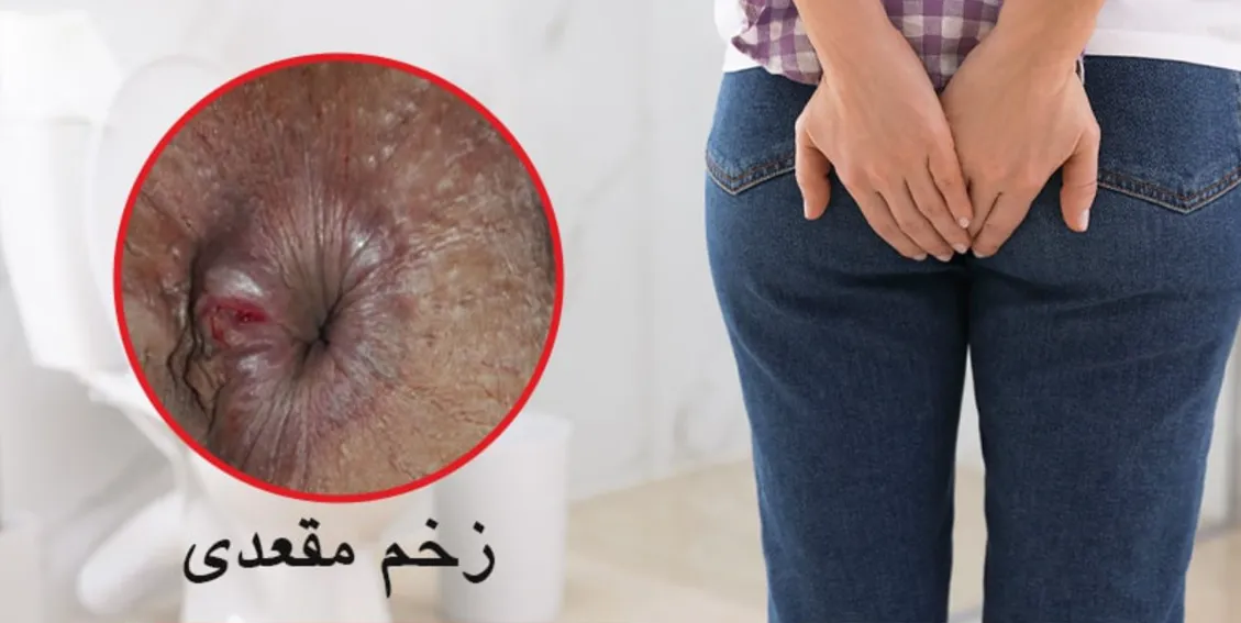 هزینه لیزر درمانی شقاق قطعی و کم هزینه در سال 1404: با بیمه