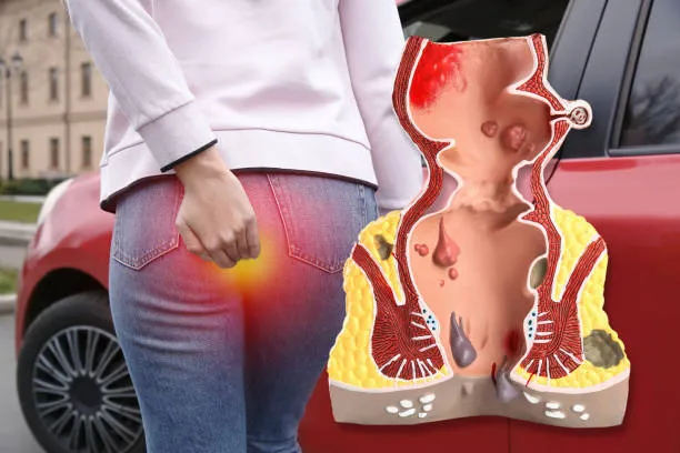 کلینیک لیزر درمان؛ بررسی علل، علائم و تشخیص دقیق بیماری های مقعدی