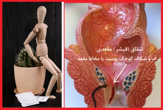 بیماری شقاق مقعدی (فیشر): علائم، علل و عوارض شایع