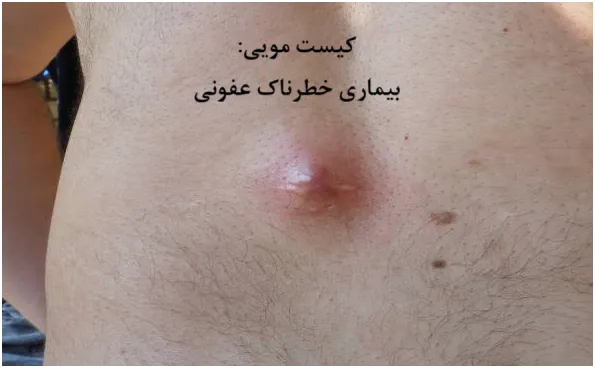 کلینیک لیزر درمان: کلینیک تخصصی درمان فوری کیست مویی