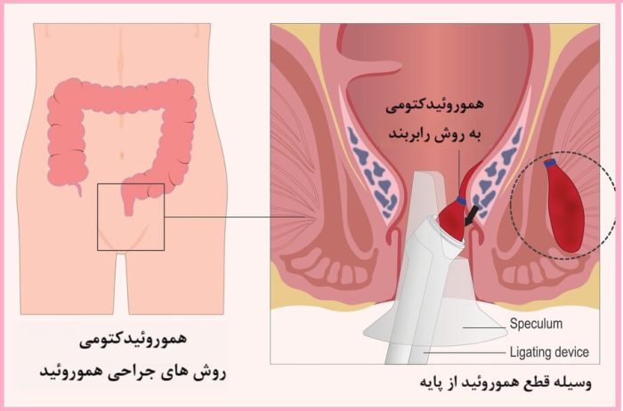 انواع روش های جراحی هموروئیدکتومی