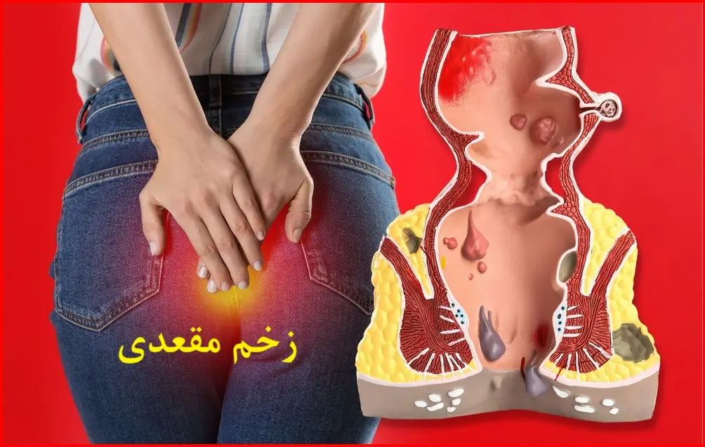 علت اصلی زخم مقعدی: ابتلا به یبوست مزمن