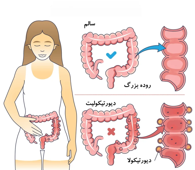 دیورتیکولیت: از علائم تا رژیم غذایی و درمان قطعی