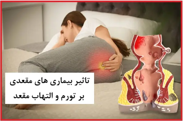 ۷ علت شایع ورم و التهاب مقعدی: از بیماری های مقعدی تا بیماری های مقاربتی