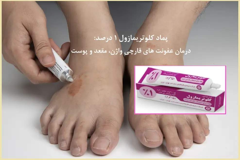 پماد کلوتریمازول ۱ درصد برای عفونت مقعد، پوست و واژن