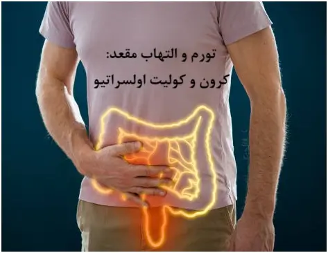 ورم مقعدی: ناشی از بیماری های التهابی روده کرون یا کولیت