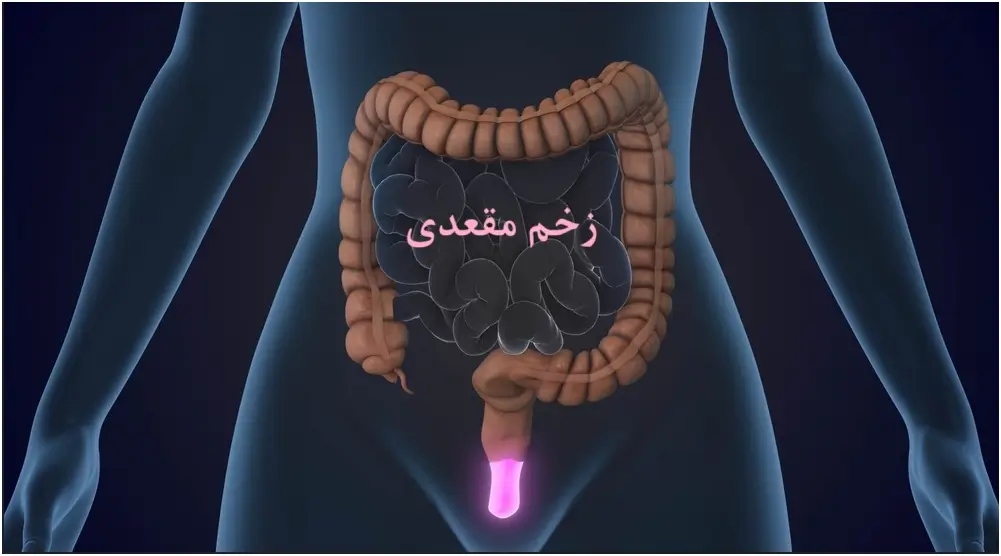زخم مقعدی: علل، علائم، روش های تشخیص و انواع درمان