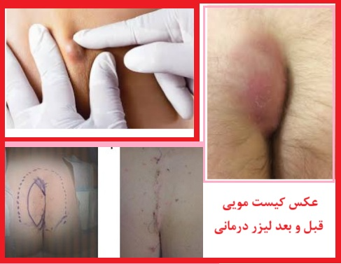 عکس کیست مویی؛ قبل و بعد از لیزر کیست مویی و مقایسه با جراحی باز