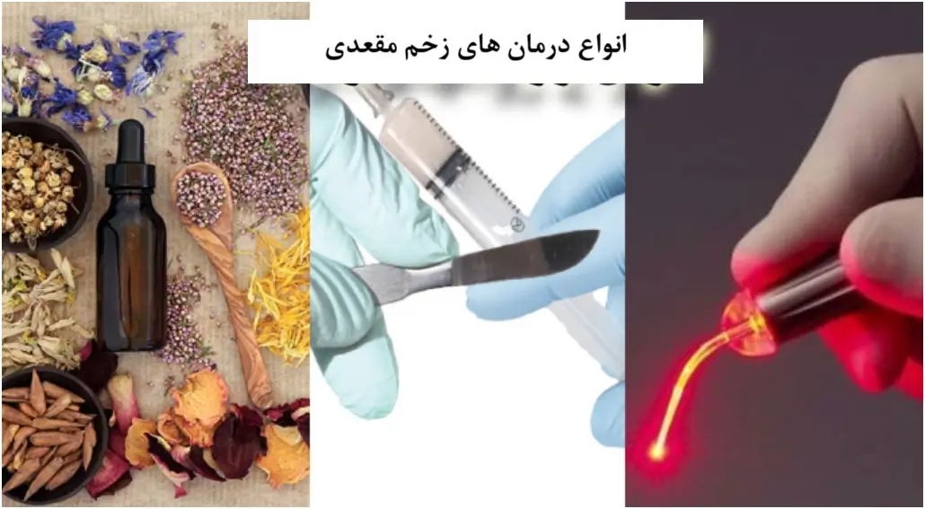 درمان زخم مقعدی: از لیزر درمانی تا درمان خانگی