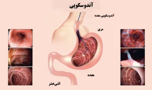 آندوسکوپی معده و روده؛ تشخیص و درمان بیماری‌های گوارشی