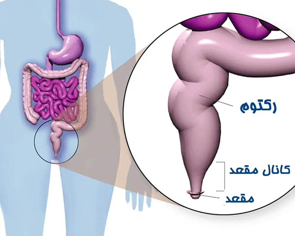 شایع ترین علل ابتلا به تنگی مقعد: از عوامل ژنتیکی تا بیماری های مقعدی